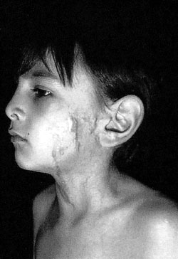 Fig. 5Fresh hypetrophic cicatrix after chemical burn.