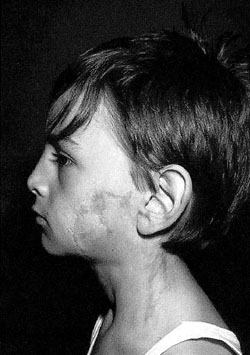 Fig. 6Three months after use of Contractubex� gel.
