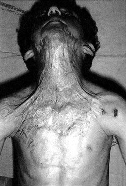 Fig. 7Untreated post-burn hypertrophic scars and graft. Scars 6 months after last  surgery.