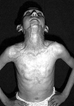 Fig. 8Three months after Contractubex� gel treatment.