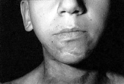 Fig. 9Mental region 10 months after Contractubex� gel treatment.