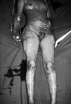 Fig. 1A 36-year-old female patient suffering from TEN. Patient after removal of all detached epidermis under i.v. ketamine anaesthesia without intubation.