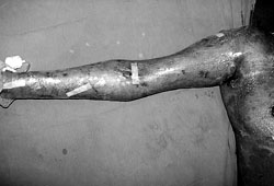 Fig. 2Omiderm� applied to right upper extremity.