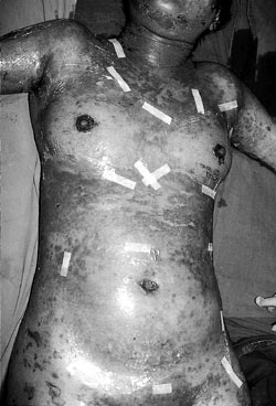 Fig. 3Omiderm� applied to trunk.
