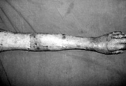 Fig. 4Glycerol-preserved human cadaver allograft applied to left upper extremity.