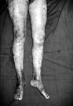 Fig. 5Glycerol-preserved human cadaver allograft applied to lower extremities.