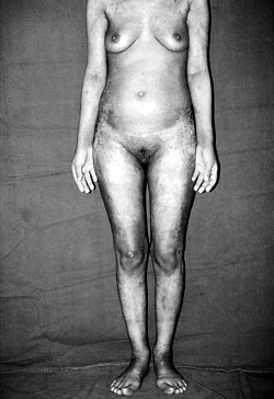 Fig. 6Patient two months after discharge from burns unit.