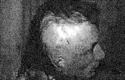 Fig. 1a21-yr-old male with burn alopecia; a 1000 cc tissue expander was used.