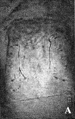 Fig. 2a22-yr-old male presenting burn scar on thorax and abdomen.<br>&nbsp