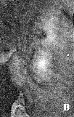 Fig. 2bTwo tissue expanders, each 500 cc, implanted in subcutaneous pockets on either side of defect.