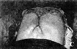 Fig. 2cImmediate post-operative result.