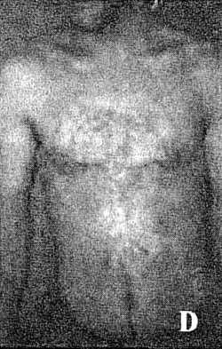 Fig. 2dPost-operative view six months after reconstruction.