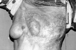 Fig. 1Severely burned left breast in 22-year-old female patient.