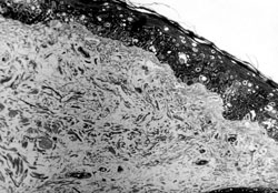 Fig. 2Structure of skin preserved at -70 �C in 199 medium with 10% glycerol for 30 days. Keratinocytes with lysed cytoplasm visible in all epidermal layers. Dermis without visible alterations (results of keratinocyte cultivation negative). Semi-thin section. Methylene blue, azure, basic fuchsin. Magnification x 750.