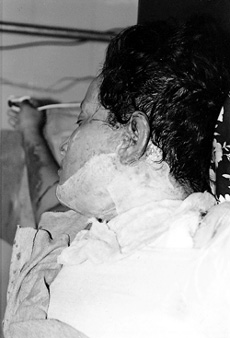 Fig. 1a Application of amniotic membrane over superficial burn involving face and neck.