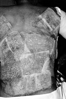 Fig. 2a Amniotic membrane applied over meshed split-skin graft following tangential excision.
