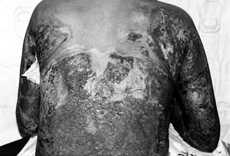 Fig. 2b Hypertrophic granulation tissue protruding through windows of meshed skin graft preventing their coalescence and concealing the original meshed skin (same patient).<br> <br> <br> <br> <br> <br>