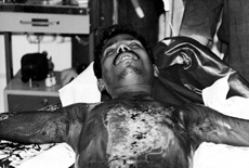Fig. 3a Dressing with amniotic membrane in patient with infected deep burn.<br> <br>