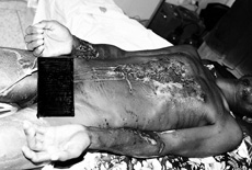 Fig. 3b Split-thickness skin graft over burn area following granulation of wound on day 10 post-operation day (same patient).