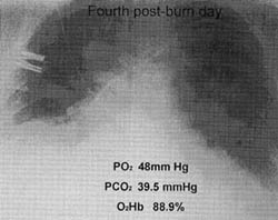 Fig. 2bSecond and fourth post-burn days.