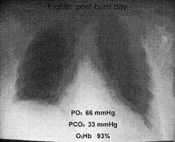 Fig. 3Eight post-burn day.