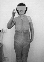 Fig. 6Smiling patient after successful treatment.