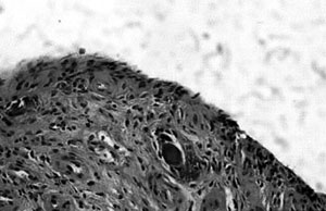 Fig. 2Graft well integrated with Hyalograft 3D. Some Hyaff fibres in the process of degradation are visible.<br>&nbsp