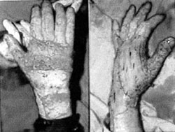 Fig. 1Peri-operative views of mesh non-expanded and sheet skin-grafts.