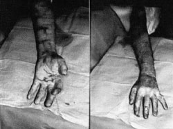 Fig. 2Post-operative views of mesh non-expande skin grafts.