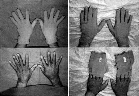 Fig. 3Follow-up views of compression gloves and functional outcome.
