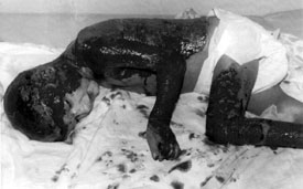 Fig. 1Clinical case. After debridement, the wound is ready for skin graft.