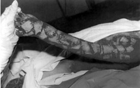 Fig. 2,3Consolidation of skin grafts in the extremities.