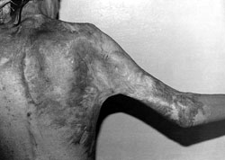 Fig. 2Posterior contracture of shoulder joint.