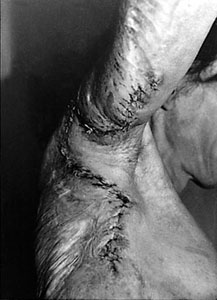 Fig. 3Correction of posterior contractures with trapezoid skin flap.