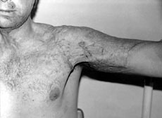 Fig. 4Anterior contracture of shoulder joint.