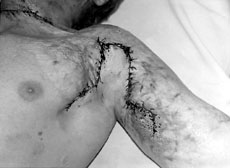 Fig. 5Correction of anterior contracture with trapezoid skin flap.