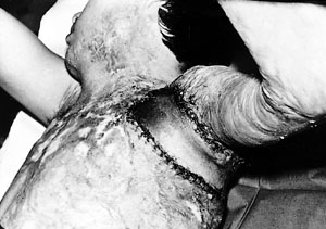 Fig. 7Correction of anterior contracures with trapezoid skin flap.