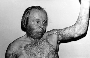 Fig. 8Correction of anterior contractures with trapezoid skin flap.