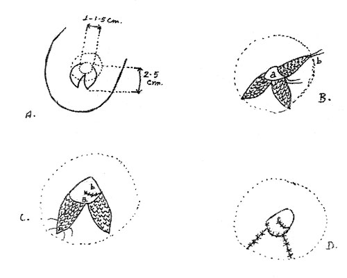 Fig.  <b>1a</b>  - Diagram of modified fishtail flap on breast. The angle between flaps may vary according to local conditions.<br><b>Fig. 1b</b>  -  Flaps are elevated with care taken at flap base to avoid vascular compromise. Flap A is rotated into position and secured.<br><b>Fig. 1c </b> -  Flap B is de-epithelialized and passed beneath flap A and secured; donor defects are closed.<br><b>Fig. 1d </b> -  Complete nipple construction.
