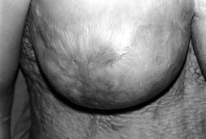 Fig. 2a20-yr-old female with post-burn deformed nipple of right breast.