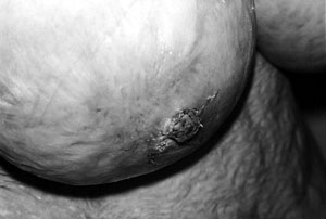 Fig. 2cPost-operative condition after one week with good nipple projection.