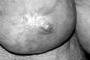Fig. 2dPost-operative condition after ten months with well-maintained nipple projection.