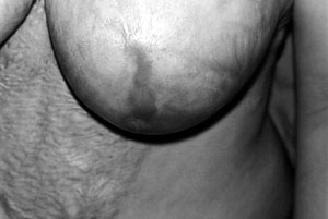 Fig. 3a18-yr-old female with post-burn deformed nipple of left breast.