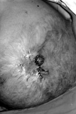 Fig. 3bIntra-operative view after closure of donor sites.