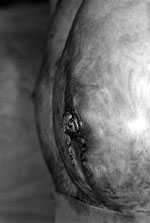 Fig. 3cLateral view showing good nipple projection after one week.<br>&nbsp<br>&nbsp