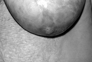 Fig. 3dPost-operative condition after one year with good nipple projection.