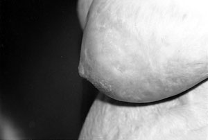 Fig. 3ePost-operative condition after 18 months (lateral view) with well-maintained nipple projection.