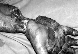 Fig. 1Extensive defect on palmar surface of right wrist following groin flap debridement.