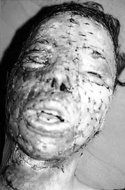 Fig. 1Patient brule jour 3 post-op�ratoire.