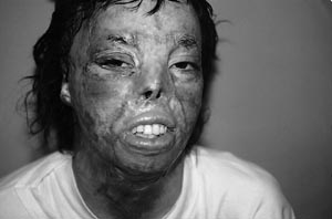 Fig. 2Aspect � 3 mois post-op�ratoire.